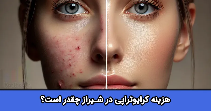 هزینه کرایوتراپی در شیراز
