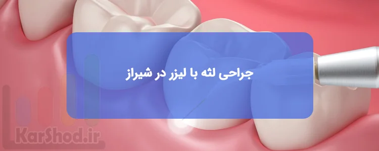 جراحی لثه با لیزر در شیراز جراحی لثه با لیزر در شیراز