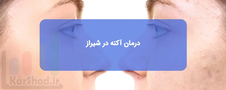 درمان آکنه در شیراز