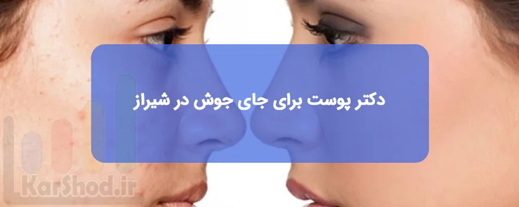 دکتر پوست برای جای جوش در شیراز دکتر پوست برای جای جوش در شیراز