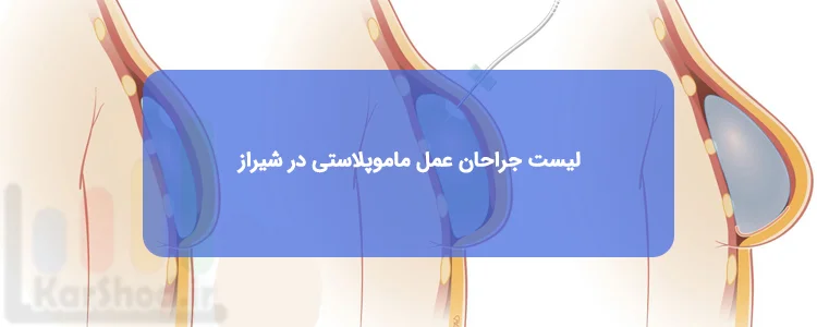 عمل ماموپلاستی در شیراز عمل ماموپلاستی در شیراز