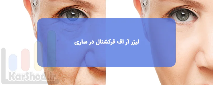 لیزر آر اف فرکشنال در ساری
