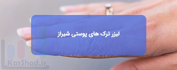 درمان ترک های پوستی با لیزر در شیراز درمان ترک های پوستی با لیزر در شیراز