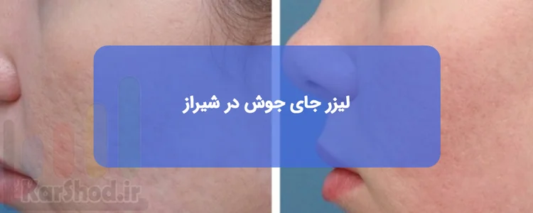 لیزر جای جوش در شیراز