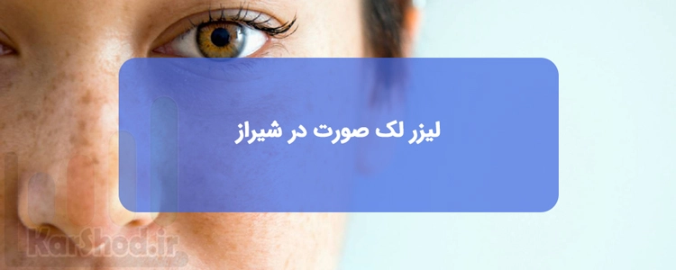 لیزر لک صورت در شیراز لیزر لک صورت در شیراز