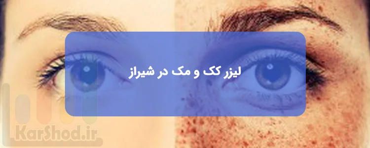 رفع کک و مک و لک پوست با لیزر در شیراز رفع کک و مک و لک پوست با لیزر در شیراز