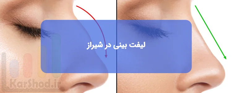 لیفت بینی در شیراز لیفت بینی در شیراز