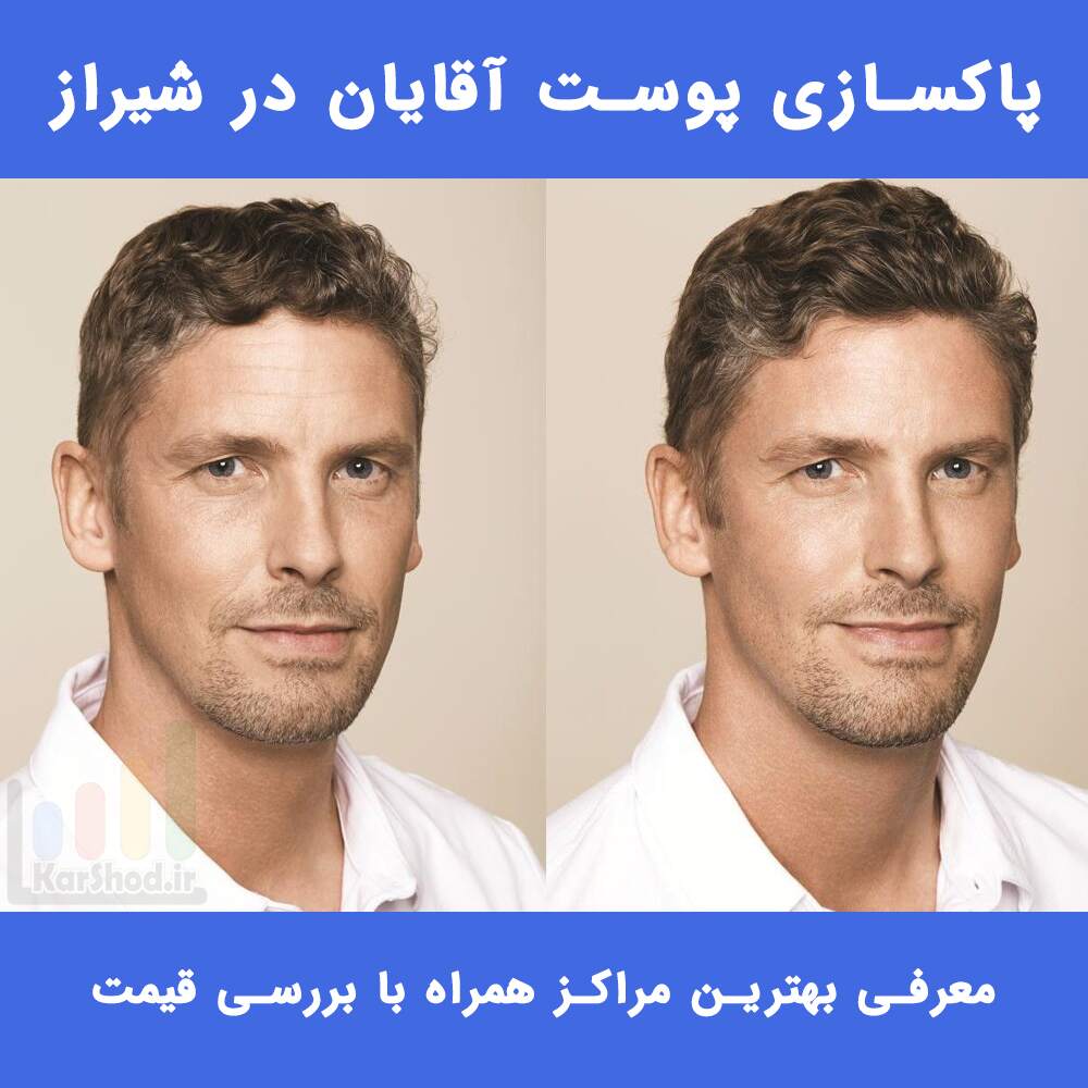 پاکسازی پوست آقایان در شیراز