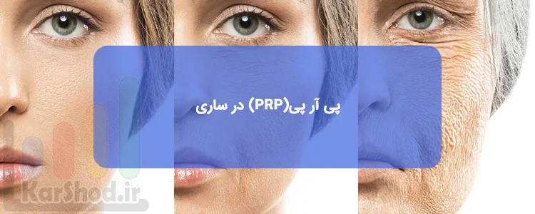 پی آر پی(PRP) در ساری