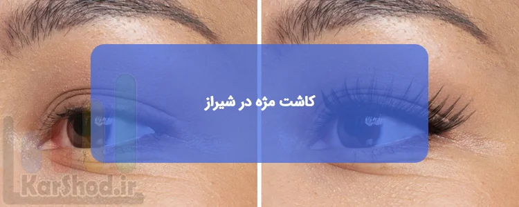 کاشت مژه در شیراز کاشت مژه در شیراز
