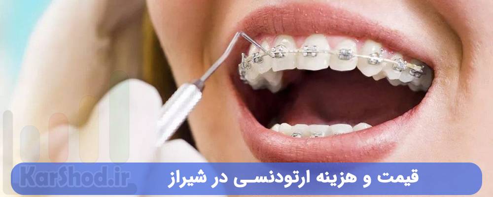 هزینه ارتودنسی در شیراز