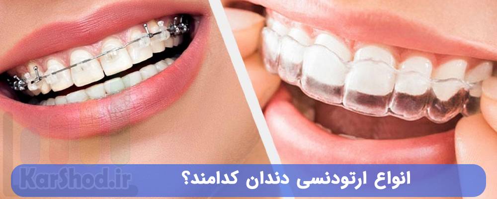 انواع ارتودنسی دندان کدامند؟