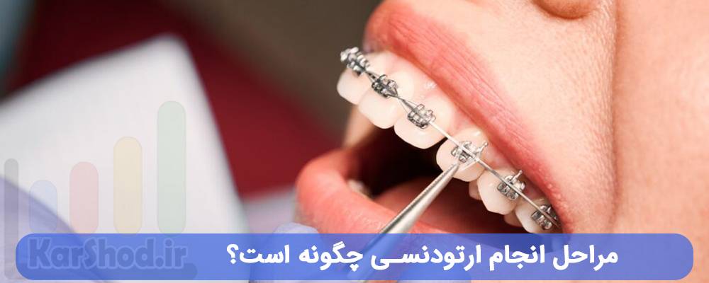 مراحل انجام ارتودنسی چگونه است؟