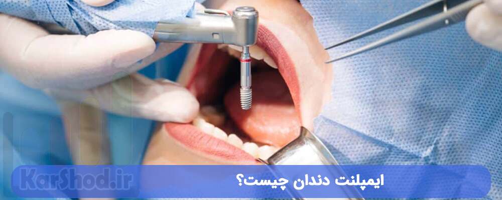 ایمپلنت دندان در شیراز