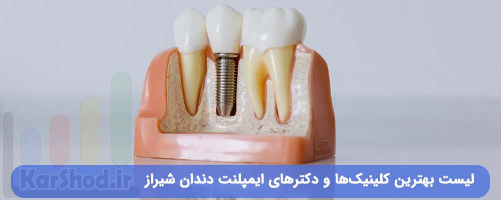 لیست بهترین دکترهای ایمپلنت دندان شیراز