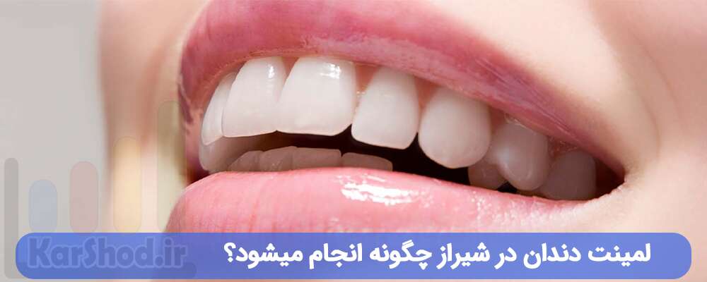 لمینت دندان در شیراز چگونه انجام میشود؟