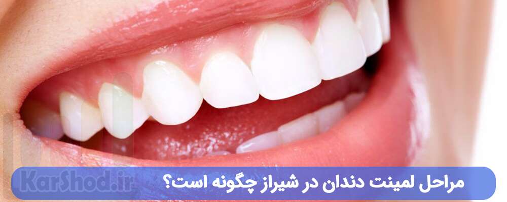 مراحل لمینت دندان در شیراز چگونه است؟