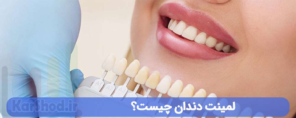 لمینت دندان چیست؟