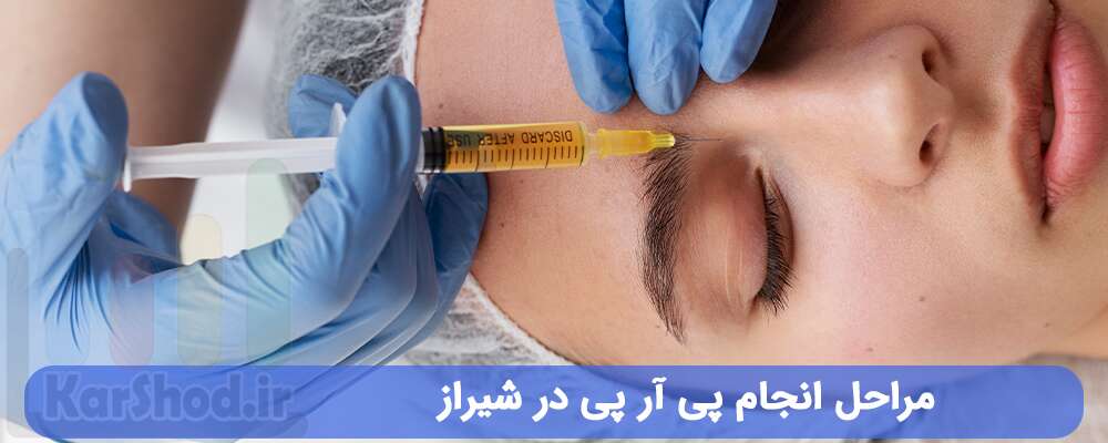 مراحل انجام پی آر پی در شیراز مراحل انجام پی آر پی در شیراز