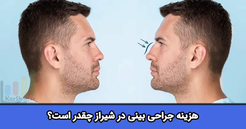 هزینه جراحی بینی در شیراز