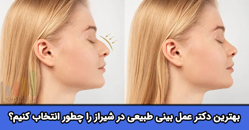 بهترین دکتر برای عمل بینی طبیعی در شیراز