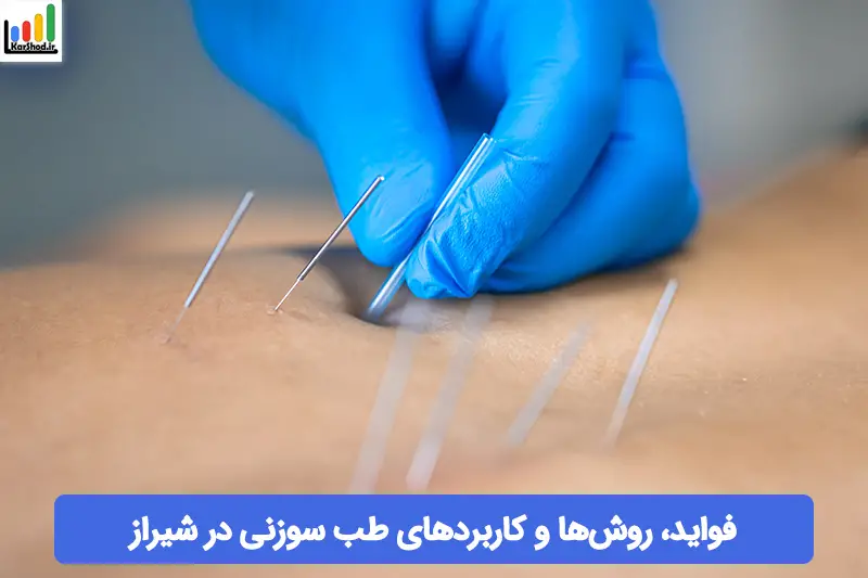 طب سوزنی در شیراز طب سوزنی در شیراز
