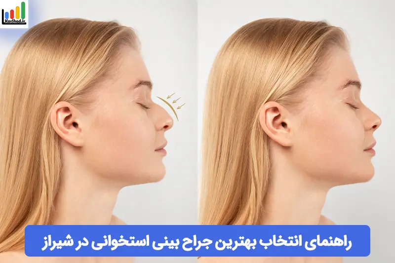 بهترین جراح بینی استخوانی در شیراز بهترین جراح بینی استخوانی در شیراز