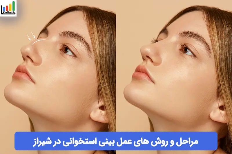 عمل بینی استخوانی در شیراز عمل بینی استخوانی در شیراز