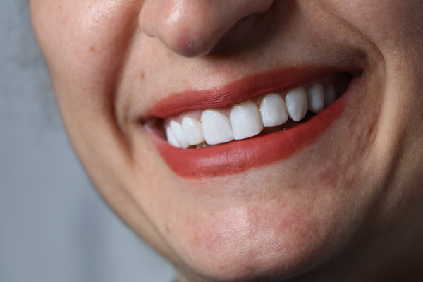 عکس های دندانپزشکی اقساطی دکتر مریم مختاری عکس های دندانپزشکی اقساطی دکتر مریم مختاری