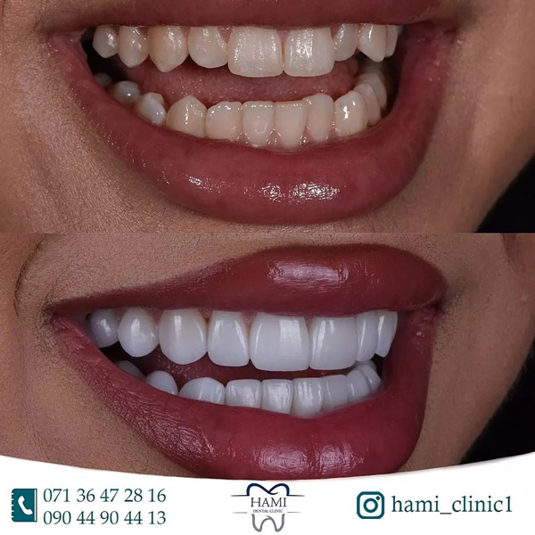 کامپوزیت دندان کامپوزیت دندان