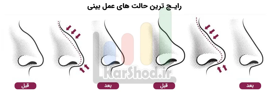 رایج‌ترین مدل‌های عمل بینی در شیراز
