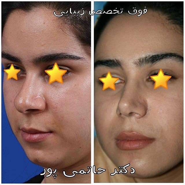 نمونه کار جراحی بینی دکتر ابراهیم حاتمی پور شیراز نمونه کار جراحی بینی دکتر ابراهیم حاتمی پور شیراز