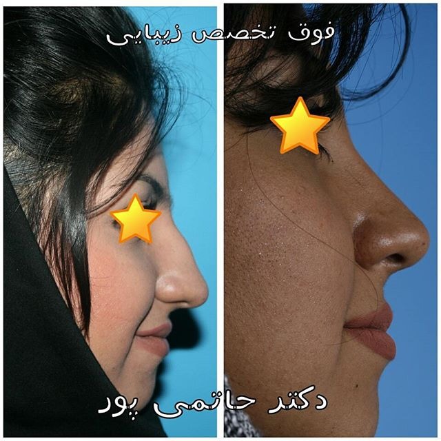 نمونه کار جراحی بینی دکتر ابراهیم حاتمی پور شیراز نمونه کار جراحی بینی دکتر ابراهیم حاتمی پور شیراز