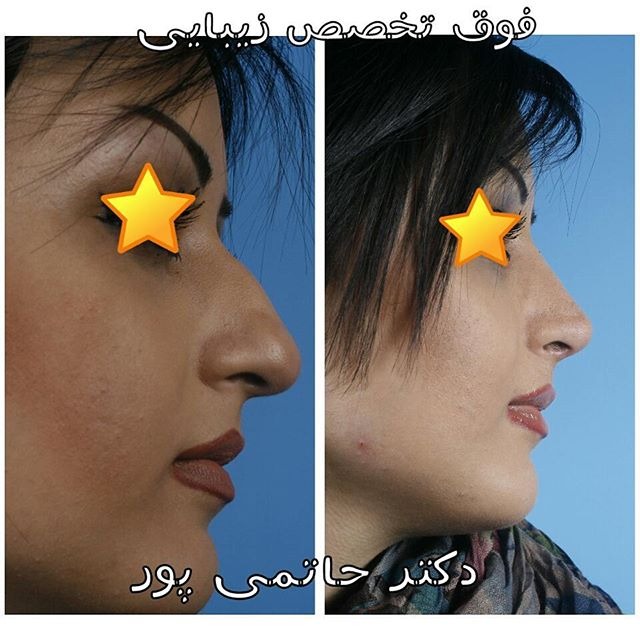 نمونه کار جراحی بینی دکتر ابراهیم حاتمی پور شیراز نمونه کار جراحی بینی دکتر ابراهیم حاتمی پور شیراز