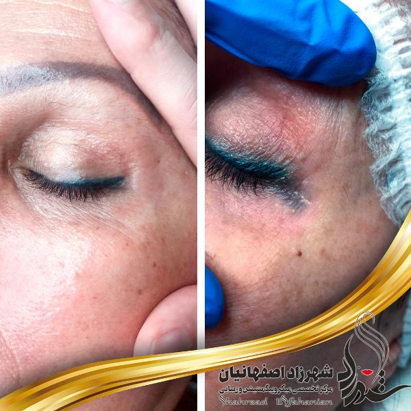 ریموو تتو خط چشم ریموو تتو خط چشم