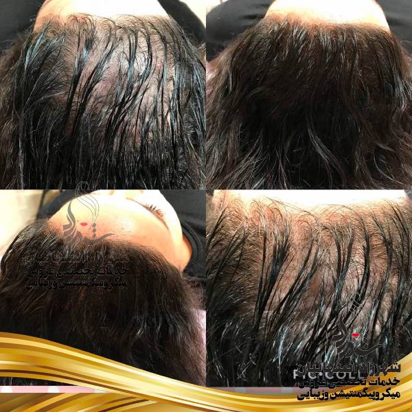 میکرو اسکالپ میکرو اسکالپ