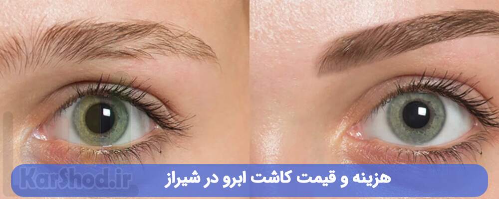 هزینه کاشت ابرو در شیراز