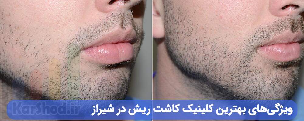 بهترین کلینیک کاشت ریش در شیراز