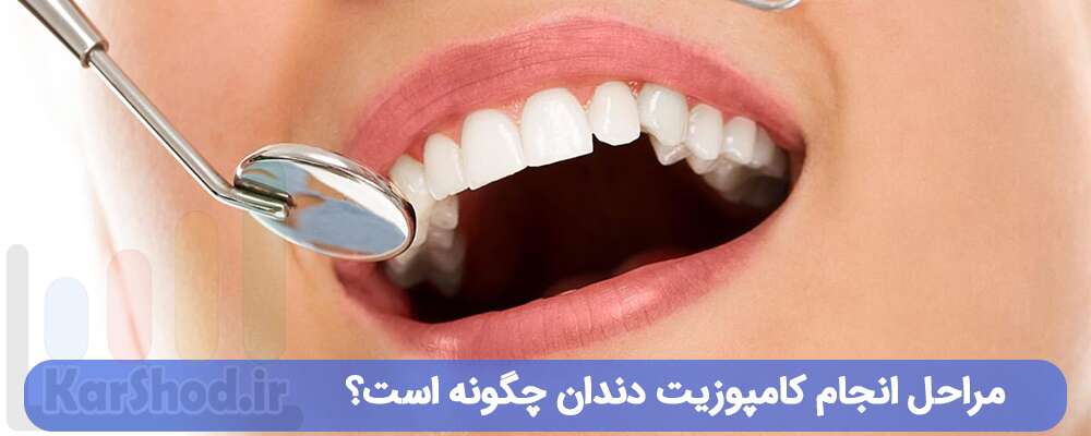 مراحل انجام کامپوزیت دندان چگونه است؟