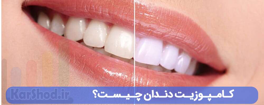 كامپوزيت دندان چیست؟